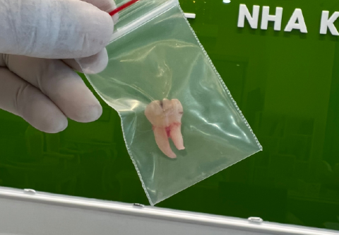 [GIẢI ĐÁP] Có nên nhổ răng khôn khi đang bị đau